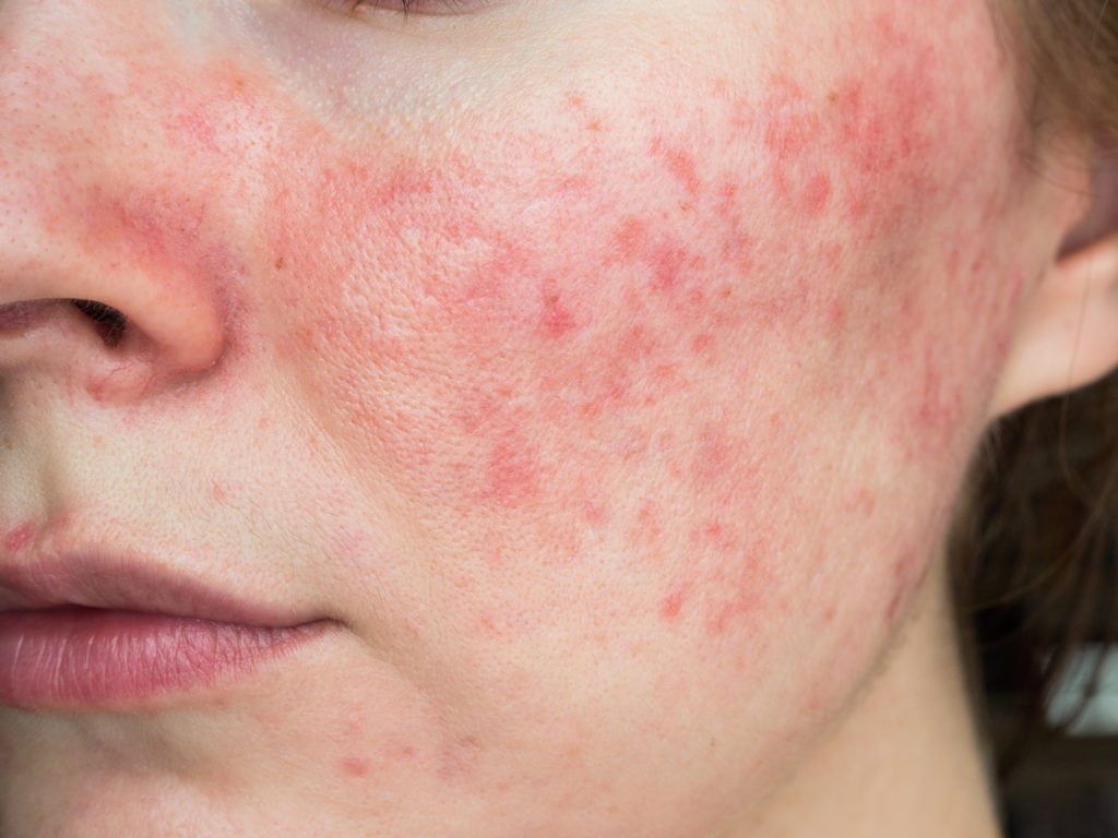 Are There Any New Treatments For Rosacea?