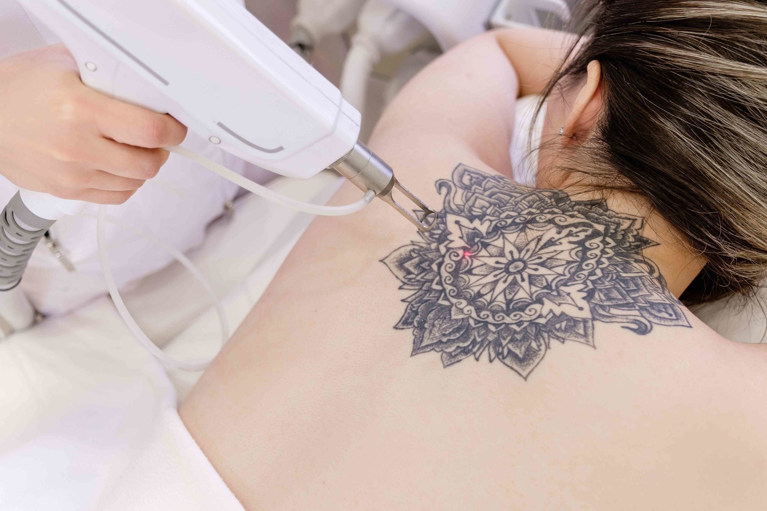 Woman Taking Tattoo Removal Treatment | CMA Primary Care & MedSpa in Windsor & Hartford, CT