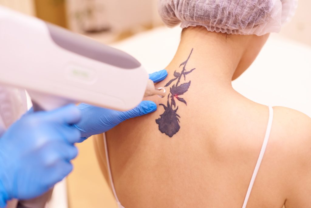 Tattoo Removal Treatment | CMA Primary Care & MedSpa in Windsor & Hartford, CT